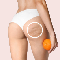 Cellulite Reduction therapy