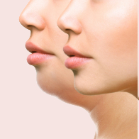 Kybella®   